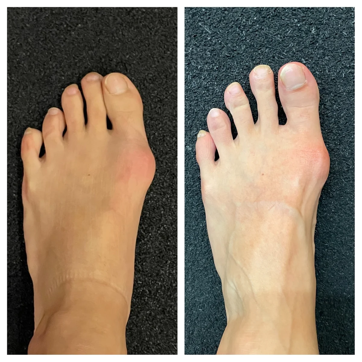 무지외반증 교정 - 교정 전후 비교 사진