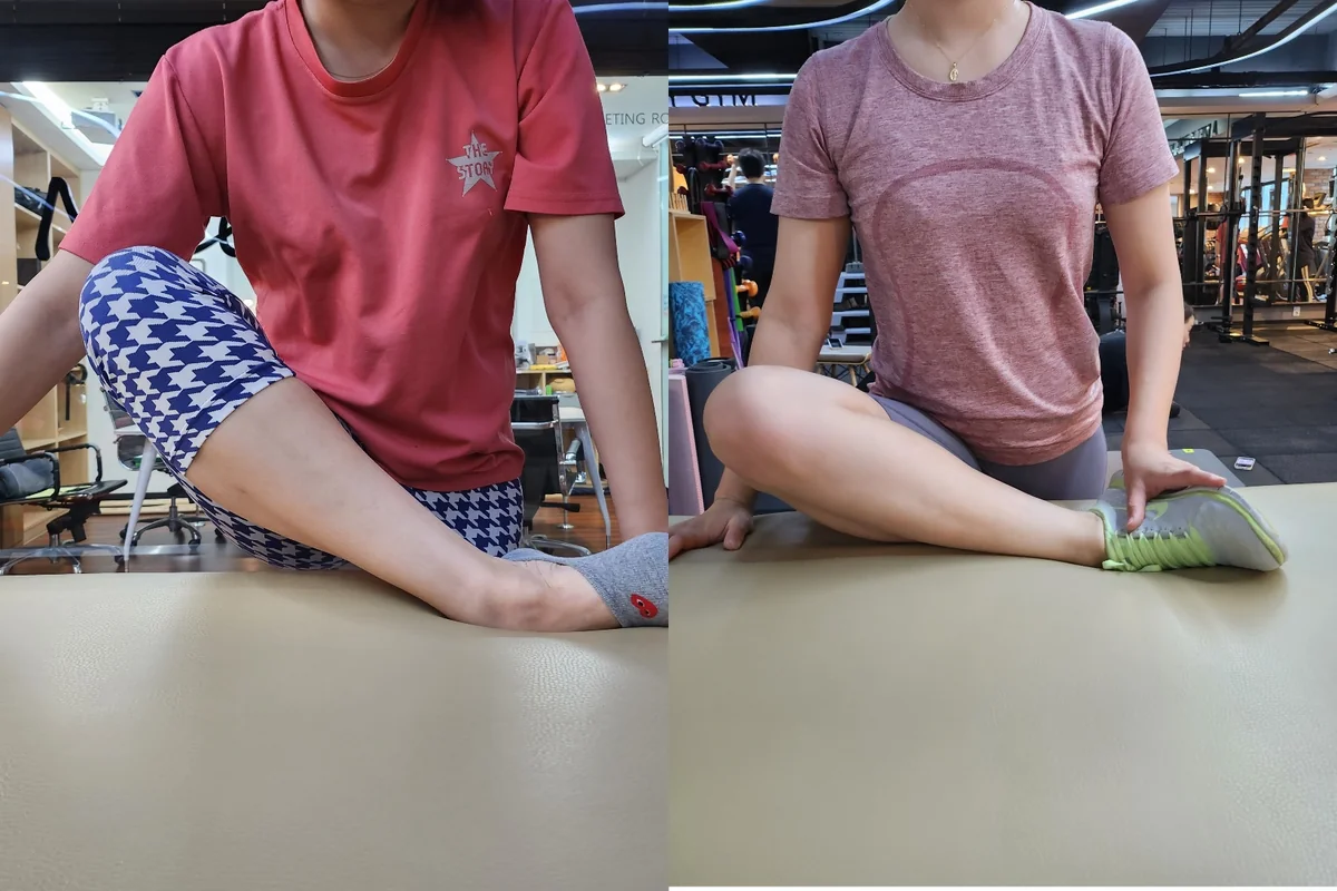 골반 교정 - 교정 전후 비교 사진