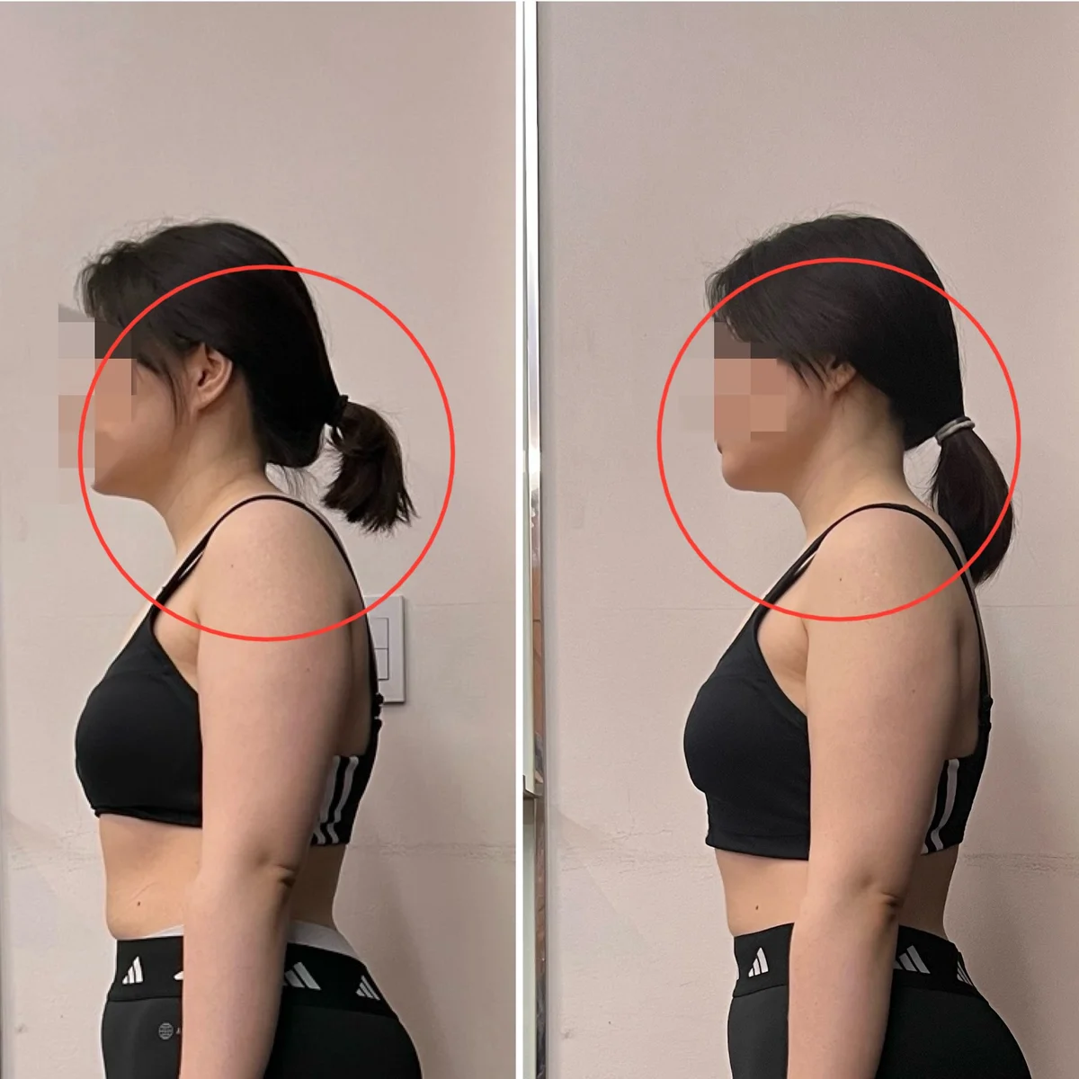 40대 주부 거북목 교정 - 교정 전후 비교 사진