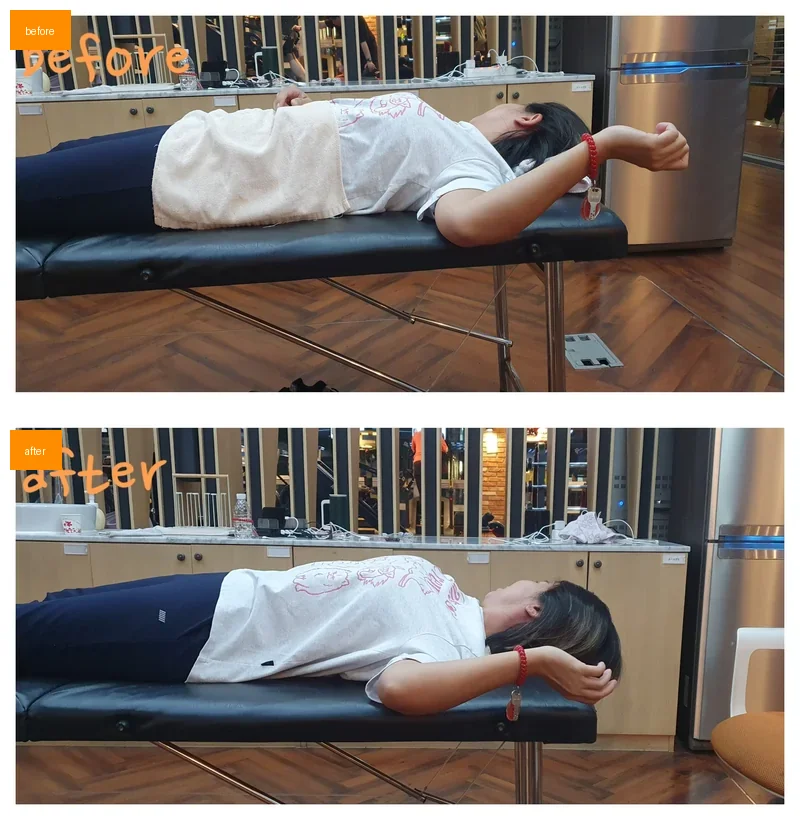 굽은등 거북목 교정 - 교정 전후 비교 사진