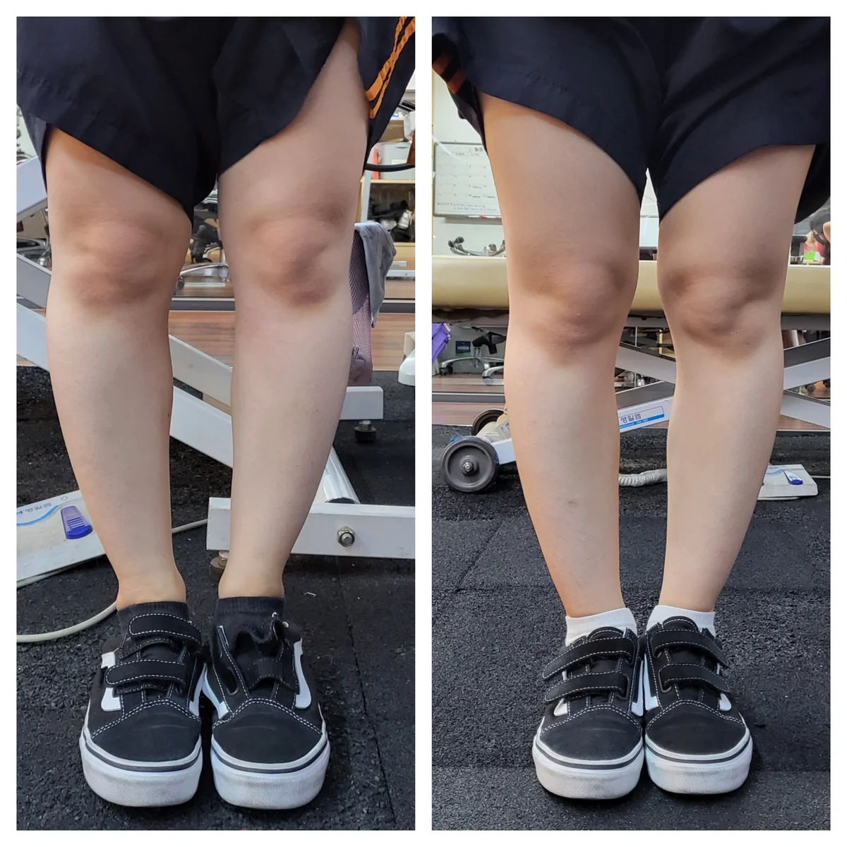 O형 다리 교정 - 교정 전후 비교 사진