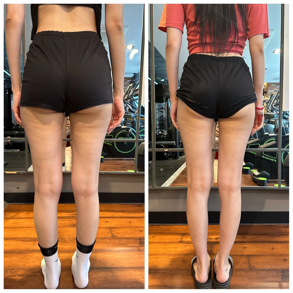 골반 다리 교정 - 교정 전후 비교 사진