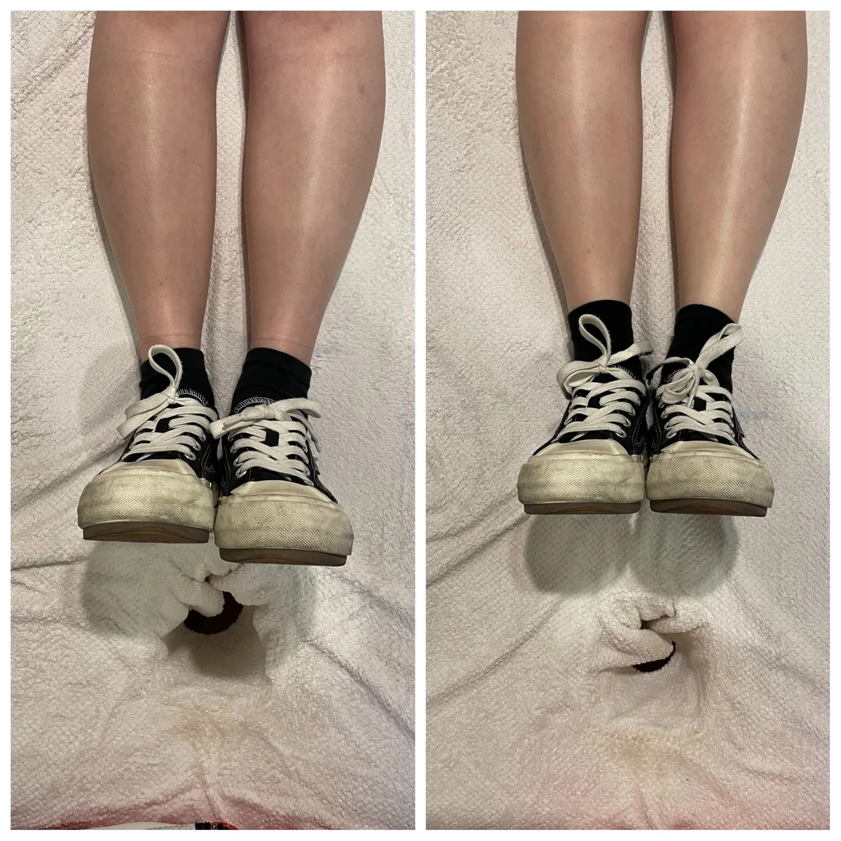 골반 다리 라인 교정 - 교정 전후 비교 사진